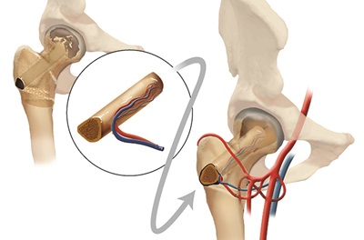 Illustration_of_microsurgical_vascularized_fibular_graft_surgery_for_avascular_necrosis_of_the_hip.